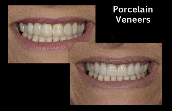 before and after of a patient who received porcelain veneers