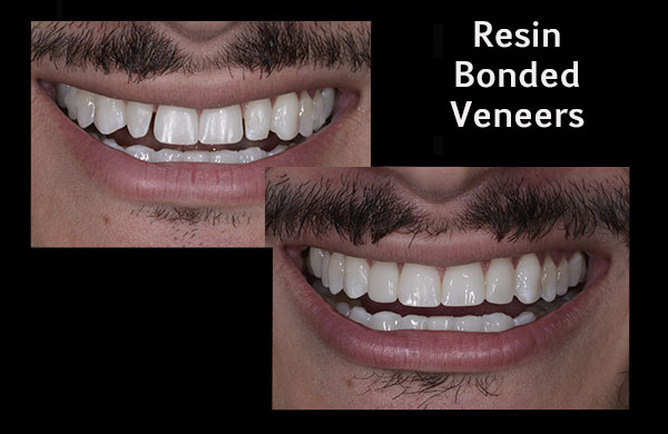 before and after of a patient who received resin bonded veneers
