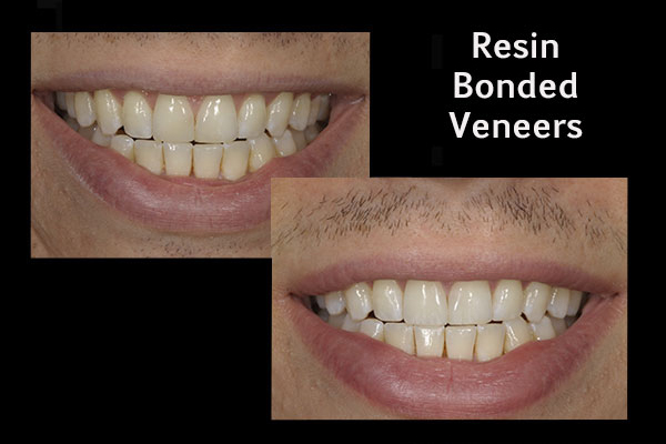 before and after of a patient who received resin bonded veneers