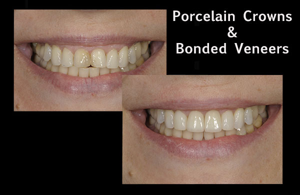 before and after of a patient who received porcelain crowns and bonded veneers