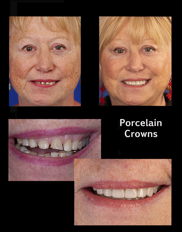 before and after of a patient who received porcelain crowns