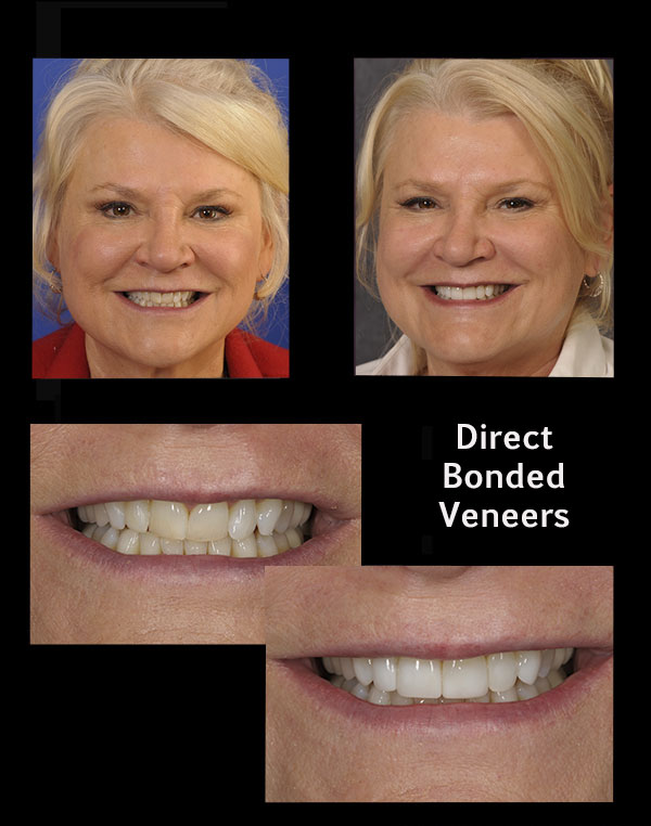 before and after of a patient who received direct bonded veneers