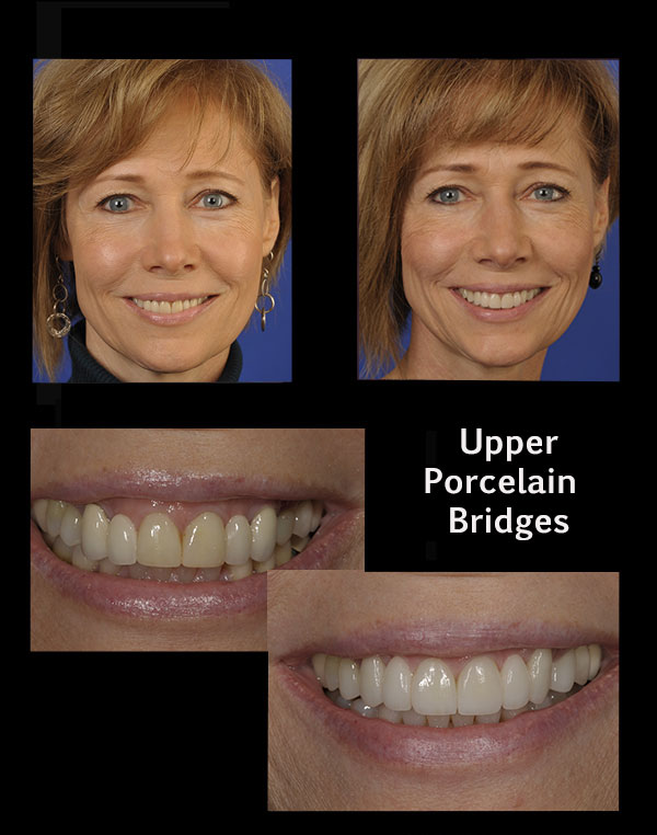before and after of a patient who upper porcelain bridges