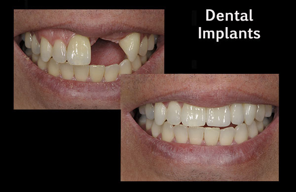 before and after of a patient who recieved dental implants