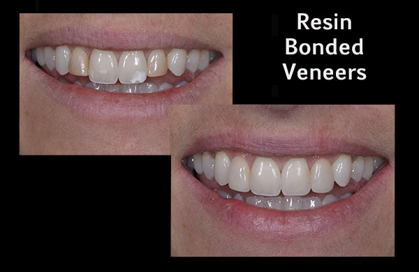 Before and after of a patient with resin bonded veneers